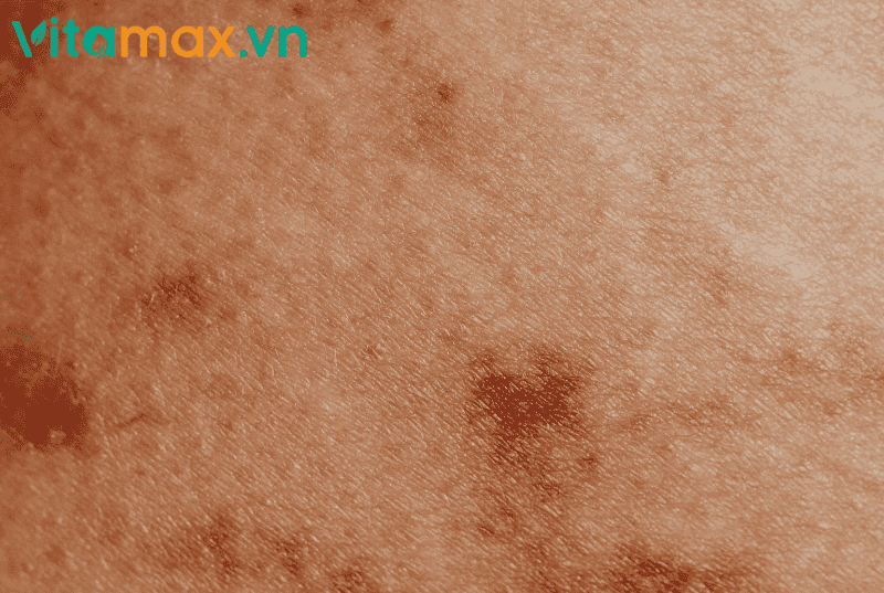 người dị ứng với nấm