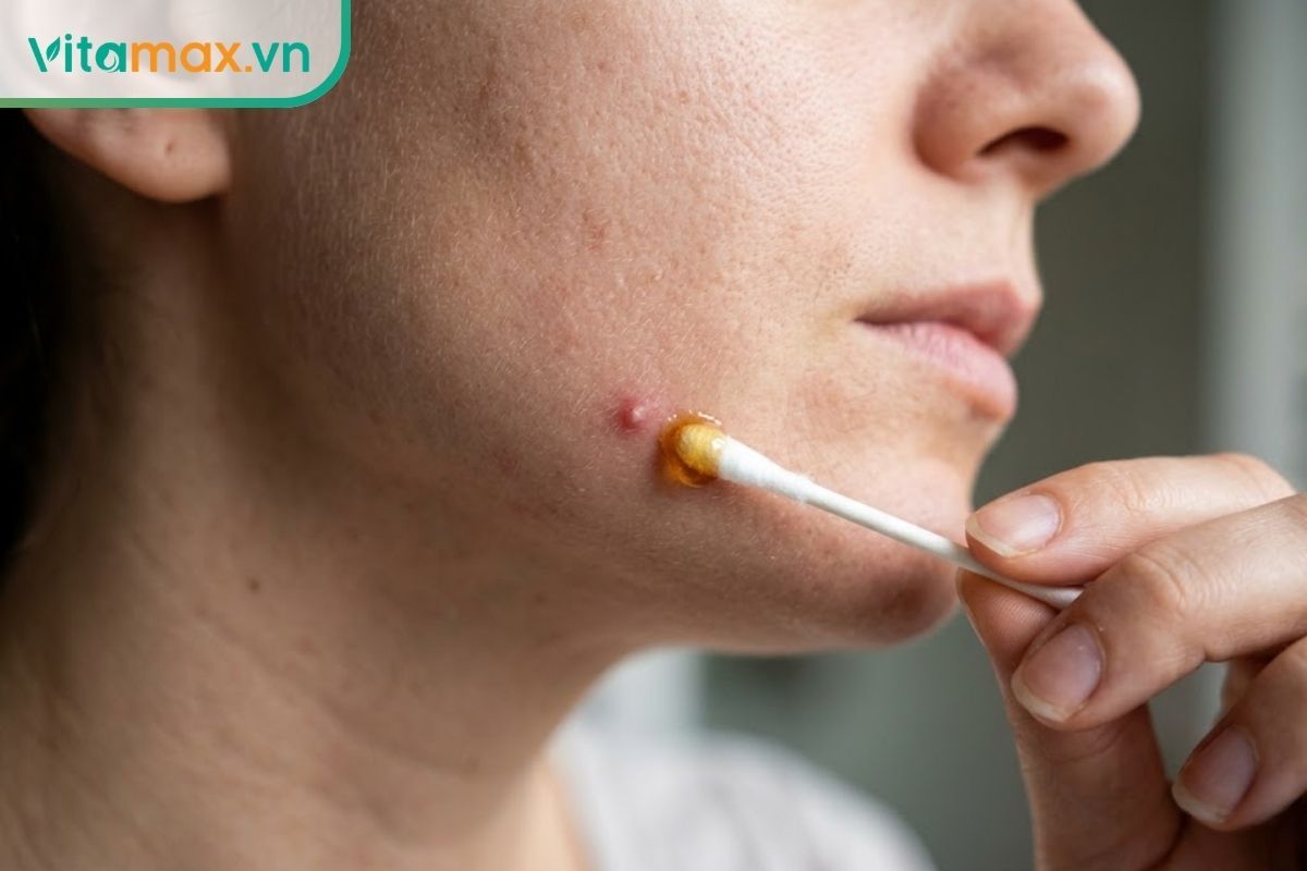 Chấm một lượng nhỏ mật ong Manuka lên nốt mụn giúp kháng khuẩn và làm dịu vùng da đang sưng đỏ.