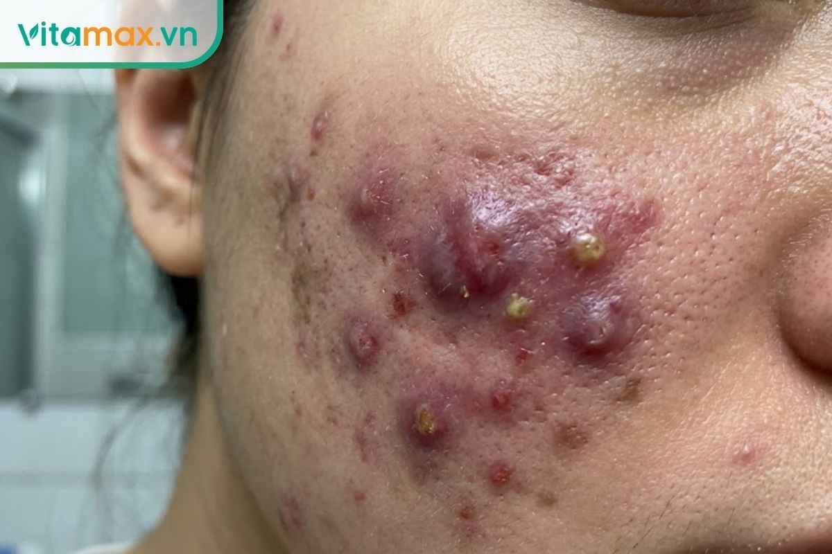 Cận cảnh vùng má bị mụn viêm nặng, sưng đỏ lan rộng - tình trạng không nên tự dùng mặt nạ mật ong trị mụn tại nhà.