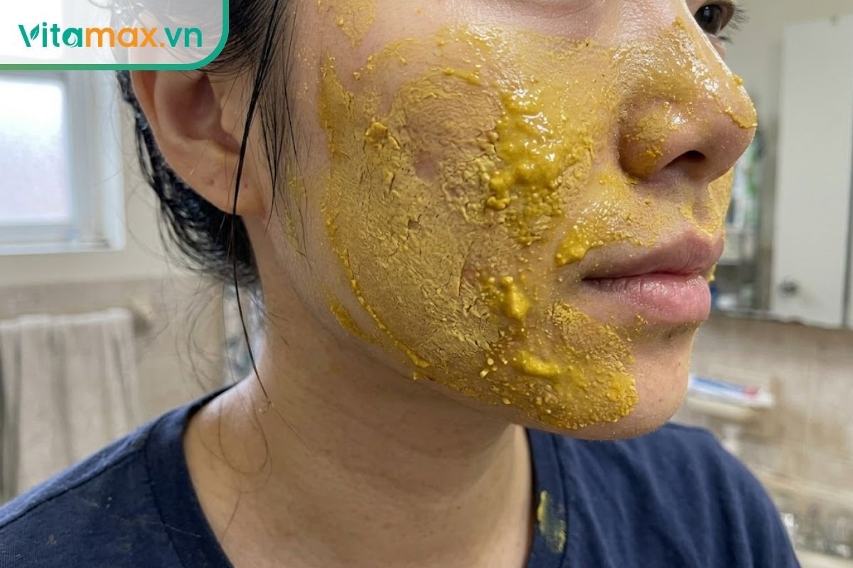 Cận cảnh lớp mặt nạ nghệ mật ong được đắp quá dày, sần sùi và vón cục trên da mặt, minh họa cho sai lầm dễ gây bí da.